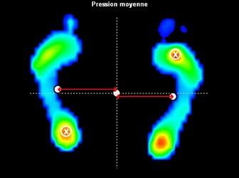 Analyse stabilométrique