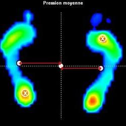 Analyse stabilométrique